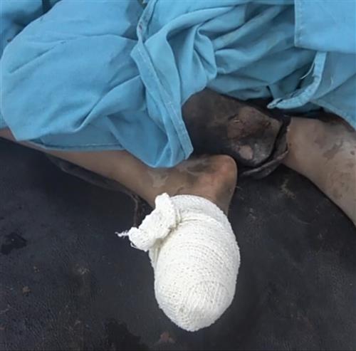 الحديدة.. إصابة طفلة بجروح بالغة إثر انفجار لغم حوثي