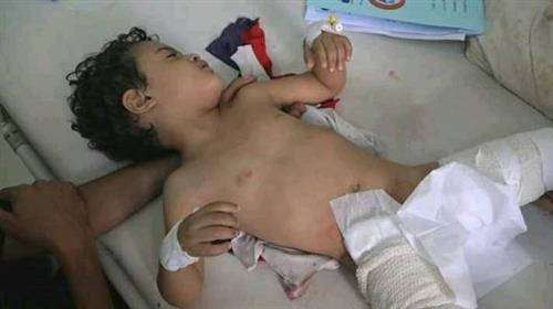 اصابة 5 أطفال في قصف حوثي على أحياء سكنية بتعز – (صور وأسماء المصابين)